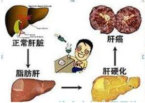 脂肪肝的“惡化”過程